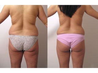 Cellulite - Dott. Carlo Lampignani