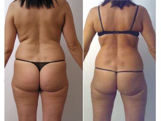 Cellulite - Dott. Carlo Lampignani
