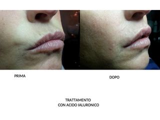 Acido ialuronico - Dott. Carlo Lampignani