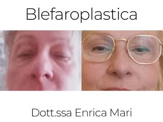 Blefaroplastica non chirurgica - Dott.ssa Enrica Mari