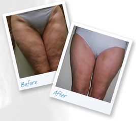 Cellulite - Lasermed Srl