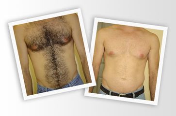 Depilazione Laser - Lasermed Srl