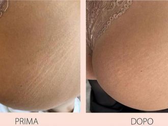 Smagliature prima e dopo - 852665