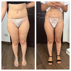 Ultrasuono e Radiofrequenza - Lasermed Srl