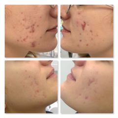 Acne - Dott.ssa Sara Saccani