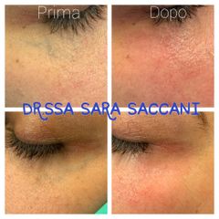 Laser Capillari Perioculari - Dott.ssa Sara Saccani