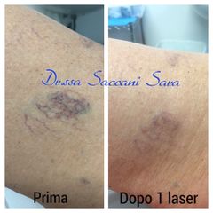Laser Capillari Gambe - Dott.ssa Sara Saccani