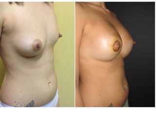 Asimmetria Mammaria prima e dopo