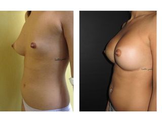 Asimmetria Mammaria prima e dopo