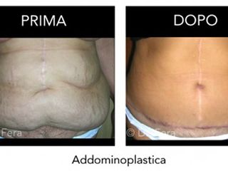 Addominoplastica prima dopo
