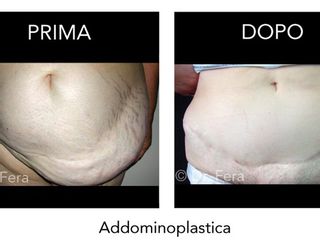 Addominoplastica prima dopo