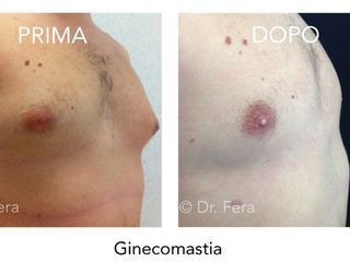 Ginecomastia prima dopo