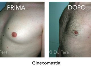 Ginecomastia prima dopo