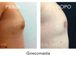 Ginecomastia prima dopo