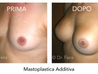 mastoplastica additiva prima dopo