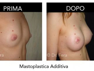 mastoplastica additiva prima dopo
