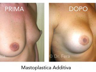 mastoplastica additiva prima dopo