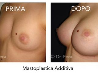 mastoplastica additiva prima dopo