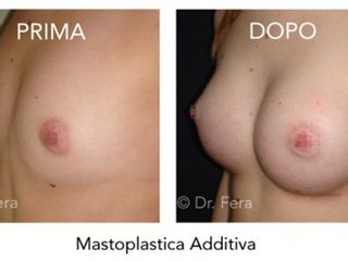 mastoplastica additiva prima dopo