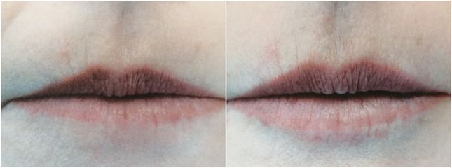 Filler labbra - Studio Medico Brenno Franceschini