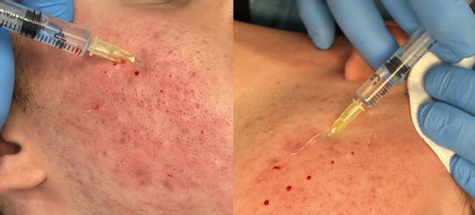 Mesoterapia, Studio Medico Brenno Franceschini