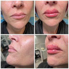 Filler labbra - Studio Medico Brenno Franceschini