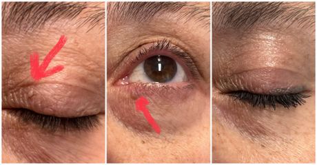 Fibromi dell’occhio PLASMA - Studio Medico Brenno Franceschini