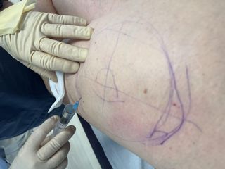 Mesoterapia per cellulite, Studio Medico Brenno Franceschini