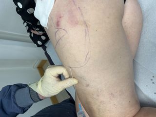 Mesoterapia per cellulite, Studio Medico Brenno Franceschini