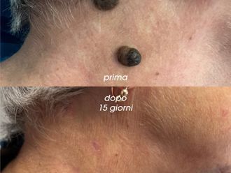 Asportazione nei prima e dopo - 876524