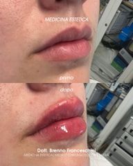 Studio Medico Brenno Franceschini Filler Labbra