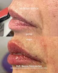 Studio Medico Brenno Franceschini Filler Labbra