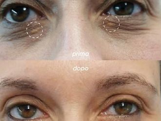 Xantelasmi prima e dopo - 876527