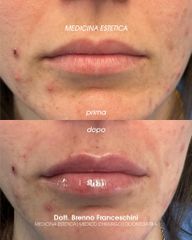 Studio Medico Brenno Franceschini Filler Labbra
