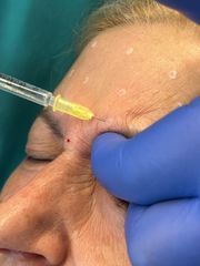 Studio Medico Brenno Franceschini Botulino