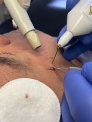 Studio Medico Brenno Franceschini plasma exeresi fibroma volto