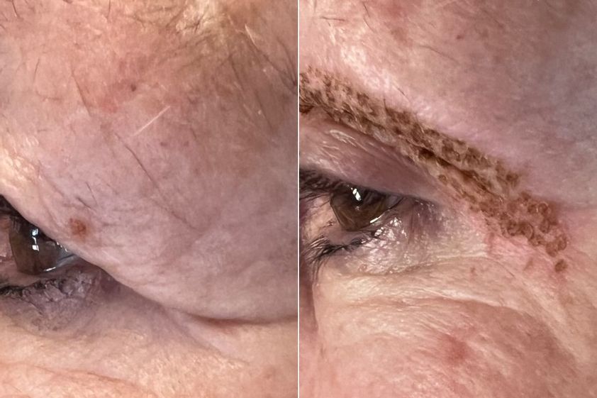 Blefaroplastica non chirurgica prima e dopo - 880737