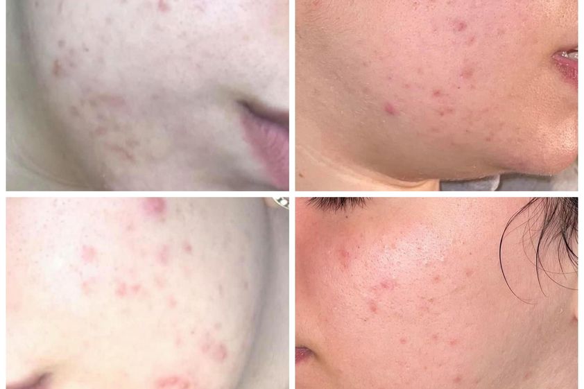Peeling chimico prima e dopo - 863571