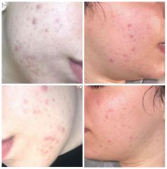 Trattamento acne con peelings