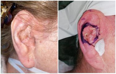 Trattamento chirurgico di carcinoma antelice orecchio
