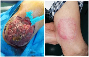 Trattamento chirurgico di carcinoma del braccio