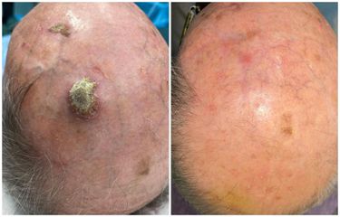 Trattamento chirurgico di carcinoma del cuoio capelluto