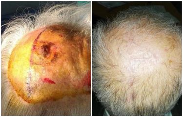 Trattamento chirurgico di carcinoma del cuoio capelluto