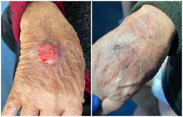 Trattamento chirurgico di carcinoma del dorso della mano