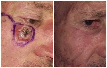 Trattamento chirurgico di carcinoma della guancia sottorbitaria
