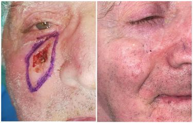 Trattamento chirurgico di carcinoma della guancia sottorbitaria
