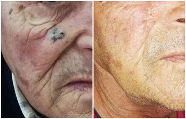 Trattamento chirurgico di carcinoma della guancia sottorbitaria