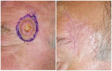 Trattamento chirurgico di carcinoma della regione temporale