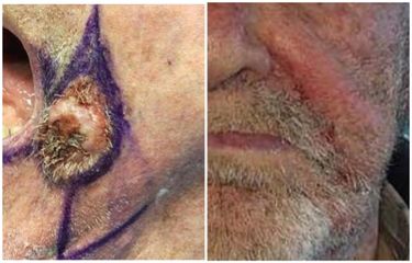 Trattamento chirurgico di carcinoma dell'angolo della bocca