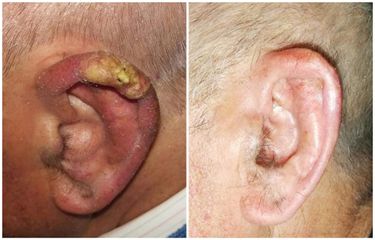 Trattamento chirurgico di carcinoma elice orecchio